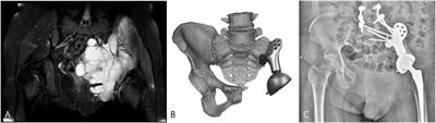 Reconstruction with 3D-printed prostheses after type I + II + III internal hemipelvectomy: Finite element analysis and preliminary outcomes